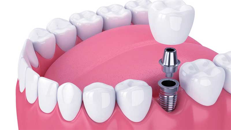 dental implants cost