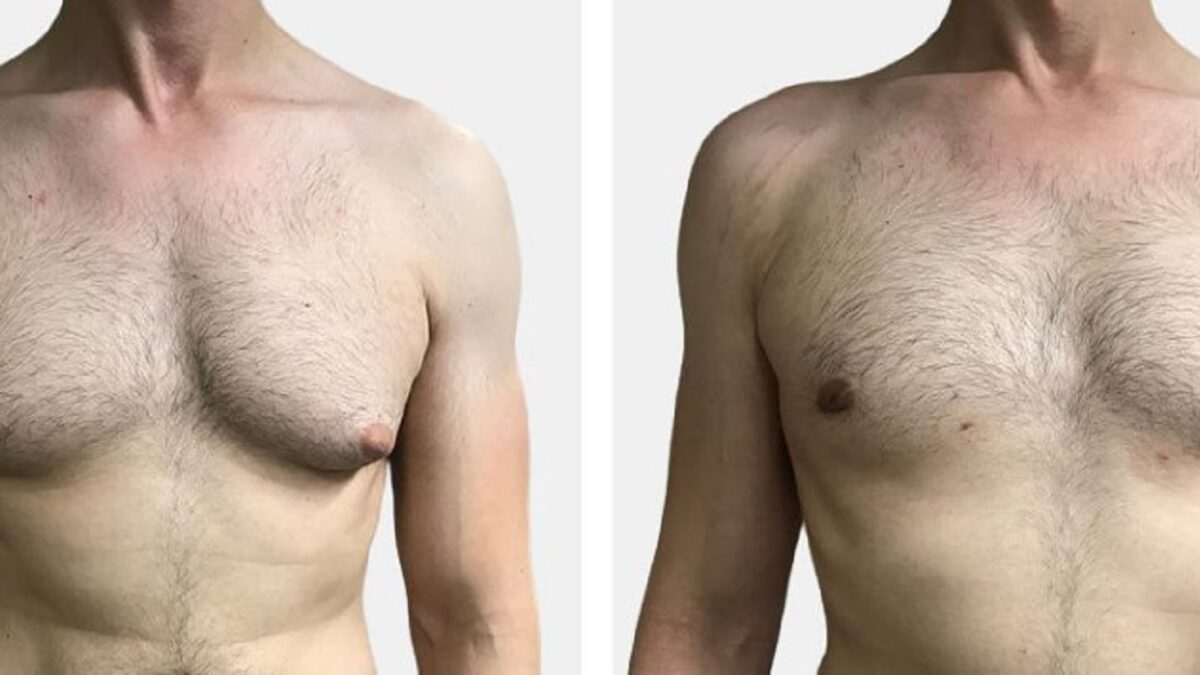 gynecomastia surgery in dubai abu dhabi sharjah