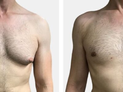 gynecomastia surgery in dubai abu dhabi sharjah