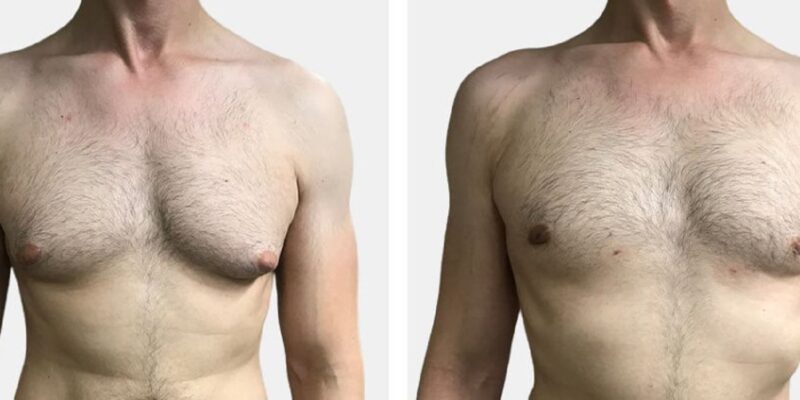 gynecomastia surgery in dubai abu dhabi sharjah