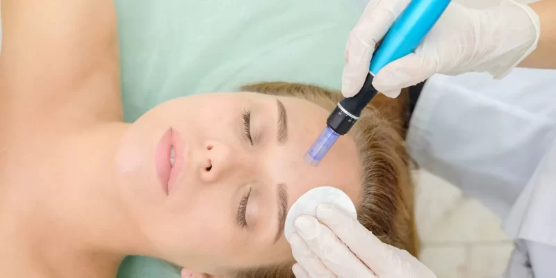 microneedling with prp