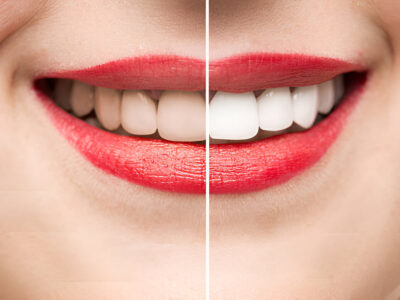 Teeth Whitening