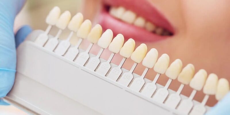 teeth whitening cardiff